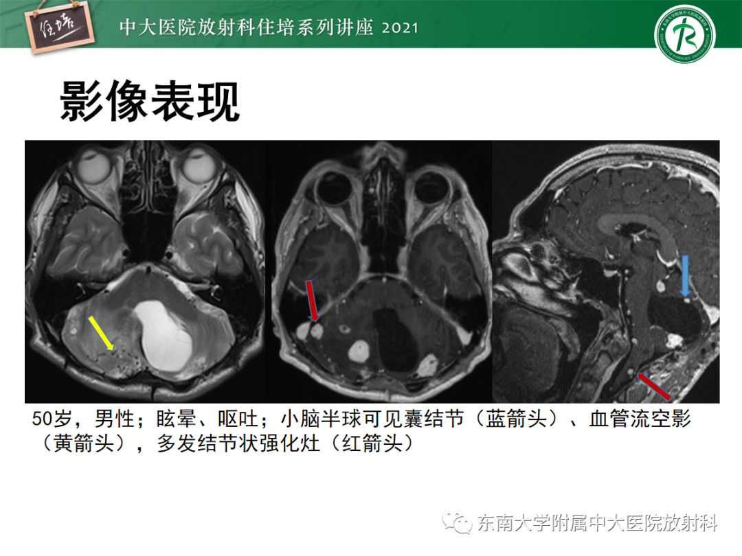 影像PPT - 【PPT】颅内多发占位的影像诊断-21