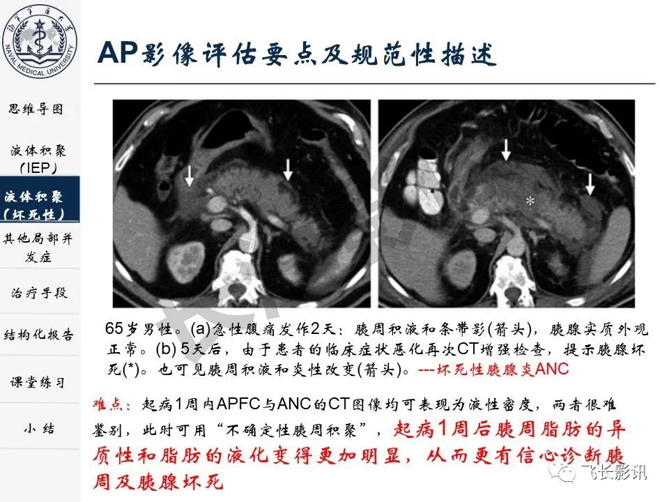 影像PPT - 【PPT】急性胰腺炎亚特兰大分级修订版解读—影像术语规范及结构化报告-15