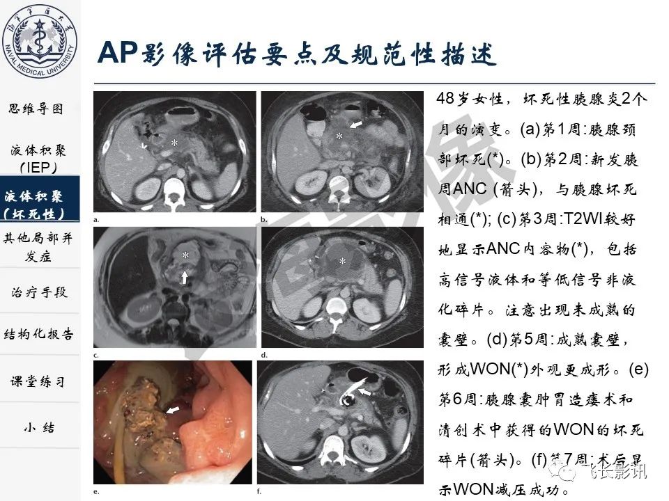 影像PPT - 【PPT】急性胰腺炎亚特兰大分级修订版解读—影像术语规范及结构化报告-18