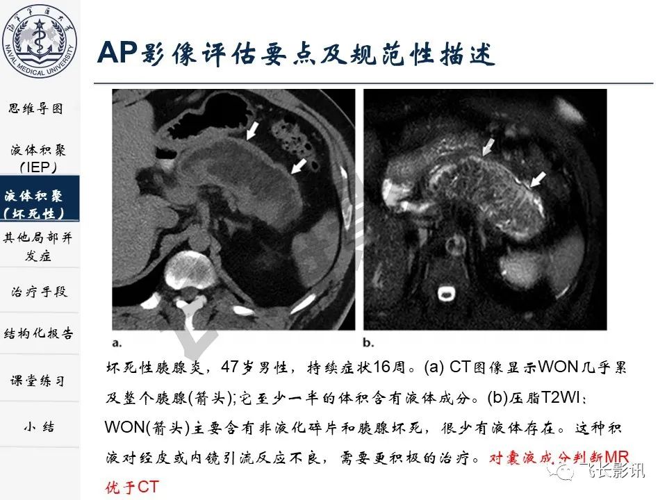 影像PPT - 【PPT】急性胰腺炎亚特兰大分级修订版解读—影像术语规范及结构化报告-19