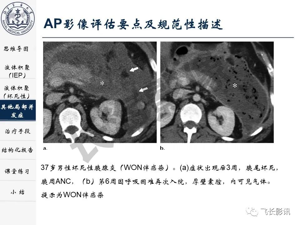 影像PPT - 【PPT】急性胰腺炎亚特兰大分级修订版解读—影像术语规范及结构化报告-21