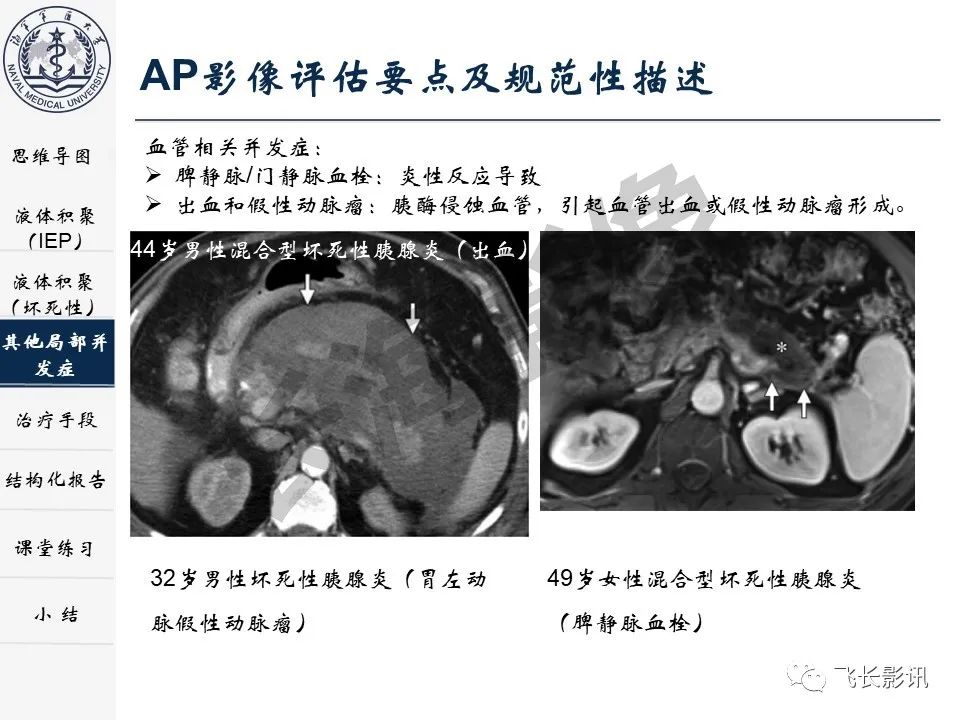 影像PPT - 【PPT】急性胰腺炎亚特兰大分级修订版解读—影像术语规范及结构化报告-22