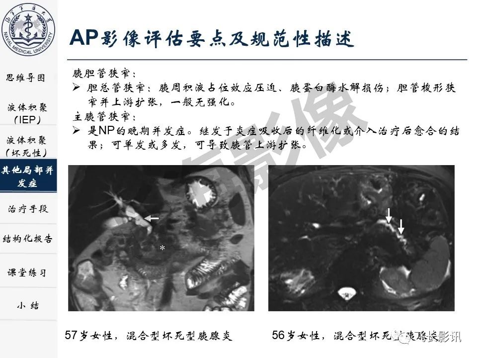 影像PPT - 【PPT】急性胰腺炎亚特兰大分级修订版解读—影像术语规范及结构化报告-24