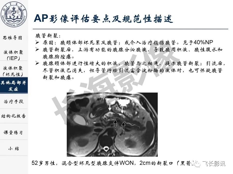 影像PPT - 【PPT】急性胰腺炎亚特兰大分级修订版解读—影像术语规范及结构化报告-25