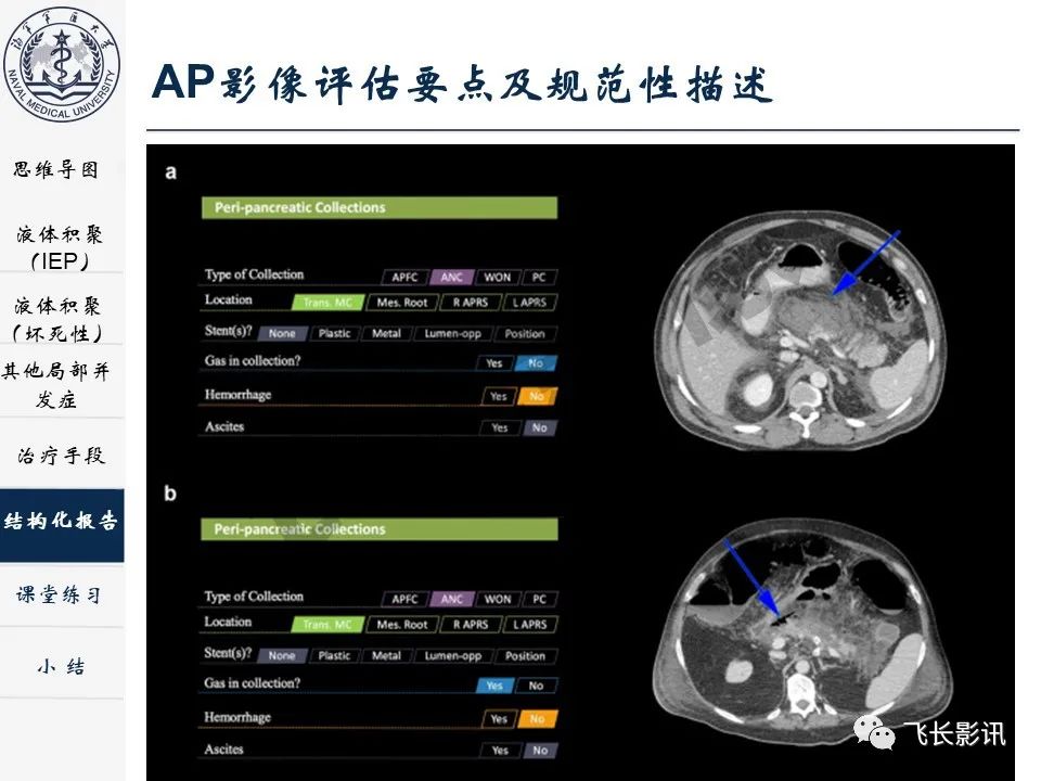 影像PPT - 【PPT】急性胰腺炎亚特兰大分级修订版解读—影像术语规范及结构化报告-31