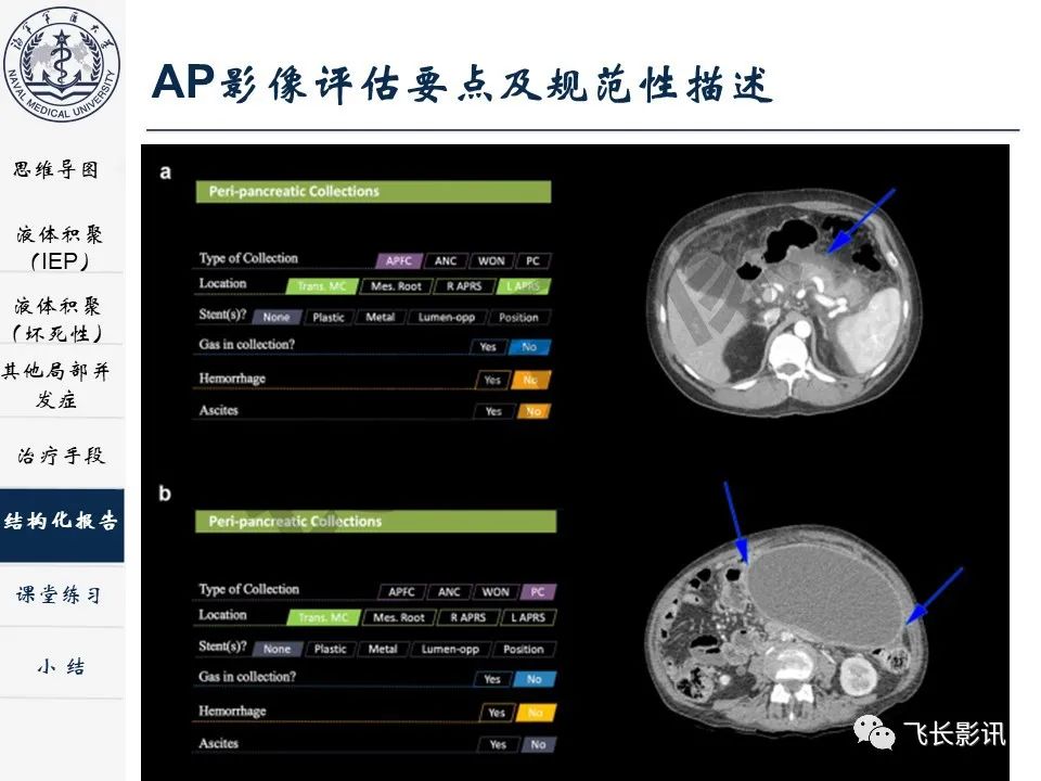 影像PPT - 【PPT】急性胰腺炎亚特兰大分级修订版解读—影像术语规范及结构化报告-32