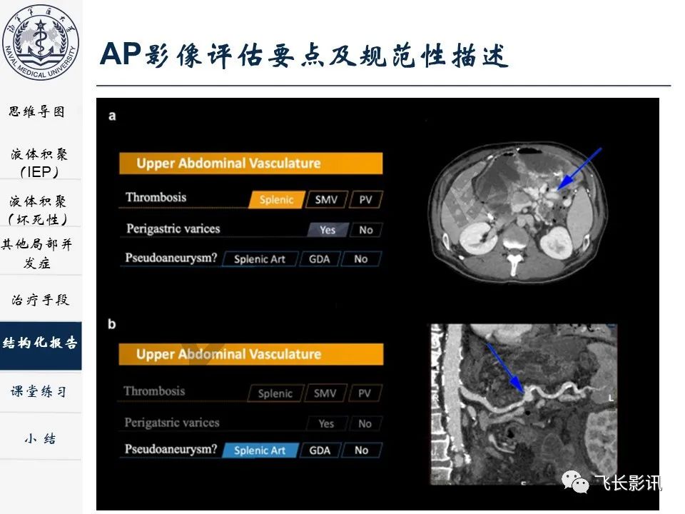 影像PPT - 【PPT】急性胰腺炎亚特兰大分级修订版解读—影像术语规范及结构化报告-33