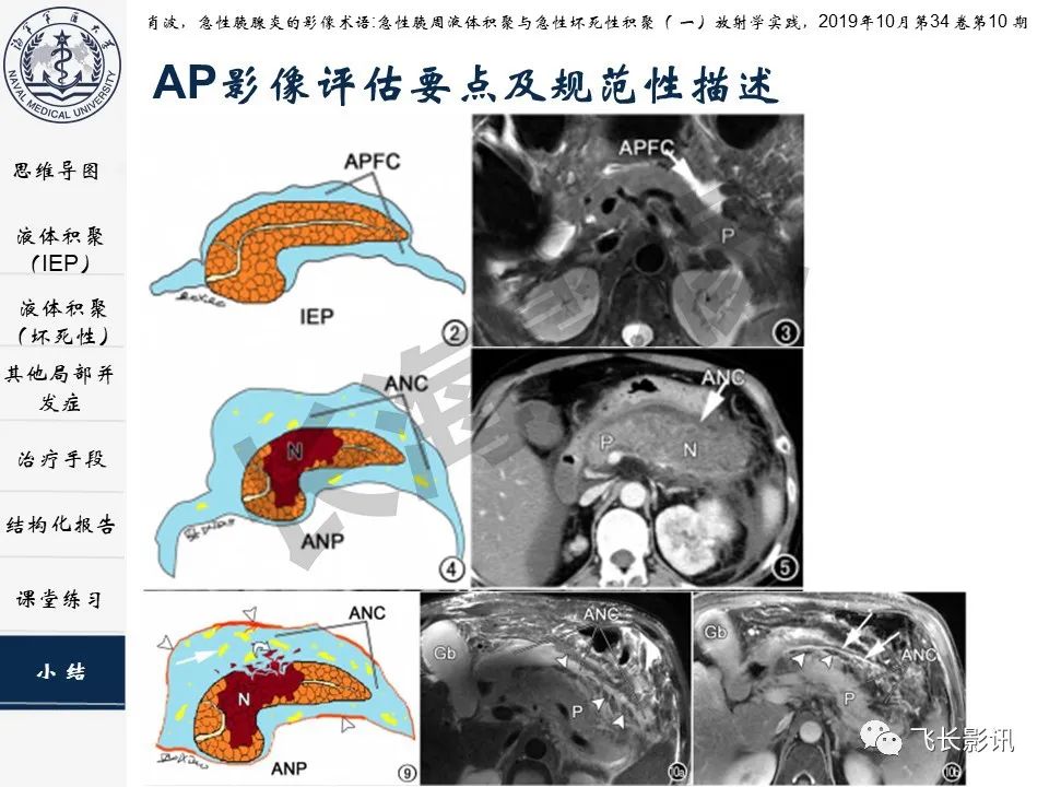 影像PPT - 【PPT】急性胰腺炎亚特兰大分级修订版解读—影像术语规范及结构化报告-36