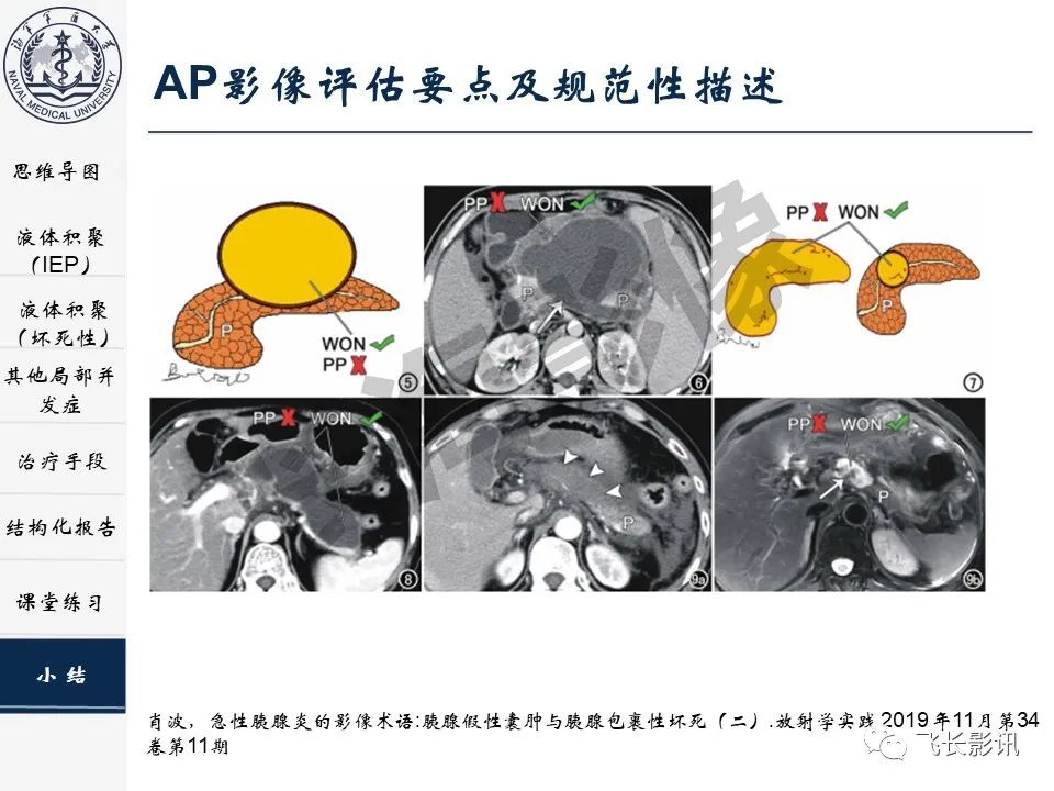 影像PPT - 【PPT】急性胰腺炎亚特兰大分级修订版解读—影像术语规范及结构化报告-39