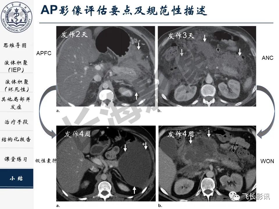 影像PPT - 【PPT】急性胰腺炎亚特兰大分级修订版解读—影像术语规范及结构化报告-40