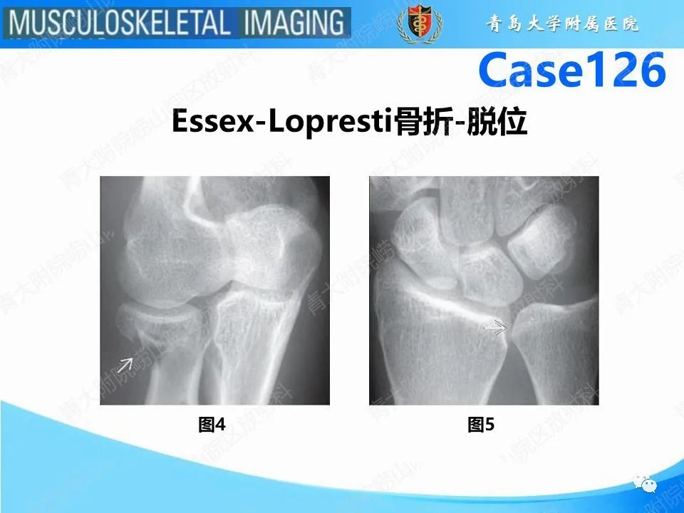 影像PPT - 【PPT】孟氏骨折—脱位-6