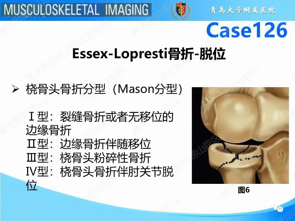 影像PPT - 【PPT】孟氏骨折—脱位-7