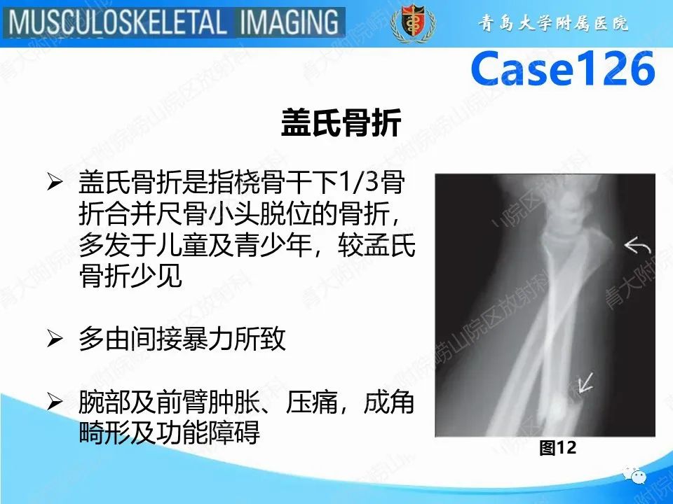 影像PPT - 【PPT】孟氏骨折—脱位-11