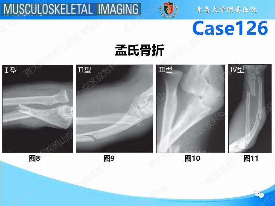 影像PPT - 【PPT】孟氏骨折—脱位-10