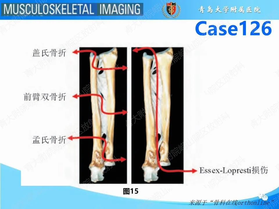 影像PPT - 【PPT】孟氏骨折—脱位-13