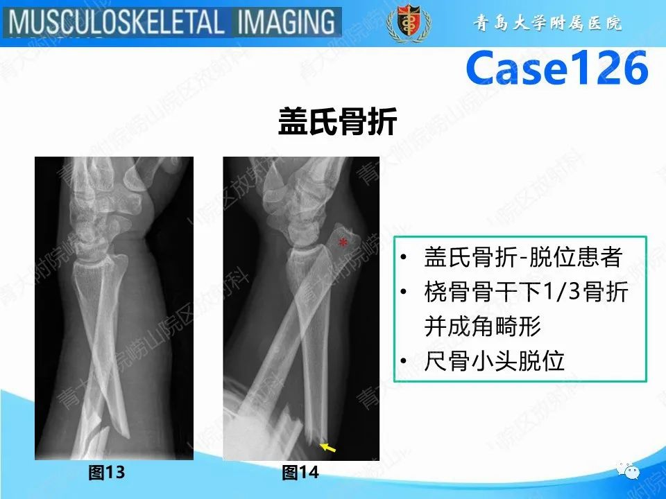 影像PPT - 【PPT】孟氏骨折—脱位-12
