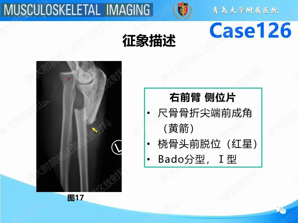 影像PPT - 【PPT】孟氏骨折—脱位-21