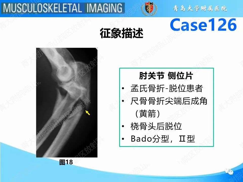 影像PPT - 【PPT】孟氏骨折—脱位-22