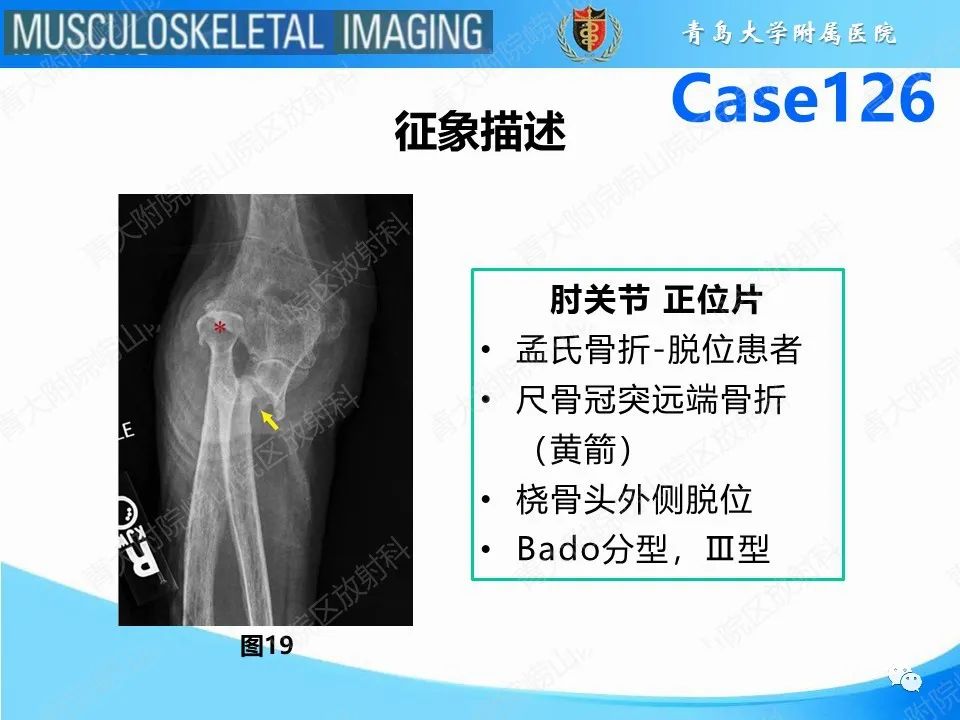 影像PPT - 【PPT】孟氏骨折—脱位-23