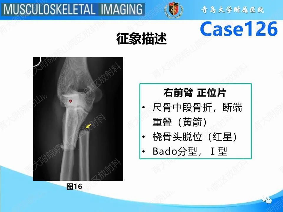 影像PPT - 【PPT】孟氏骨折—脱位-20