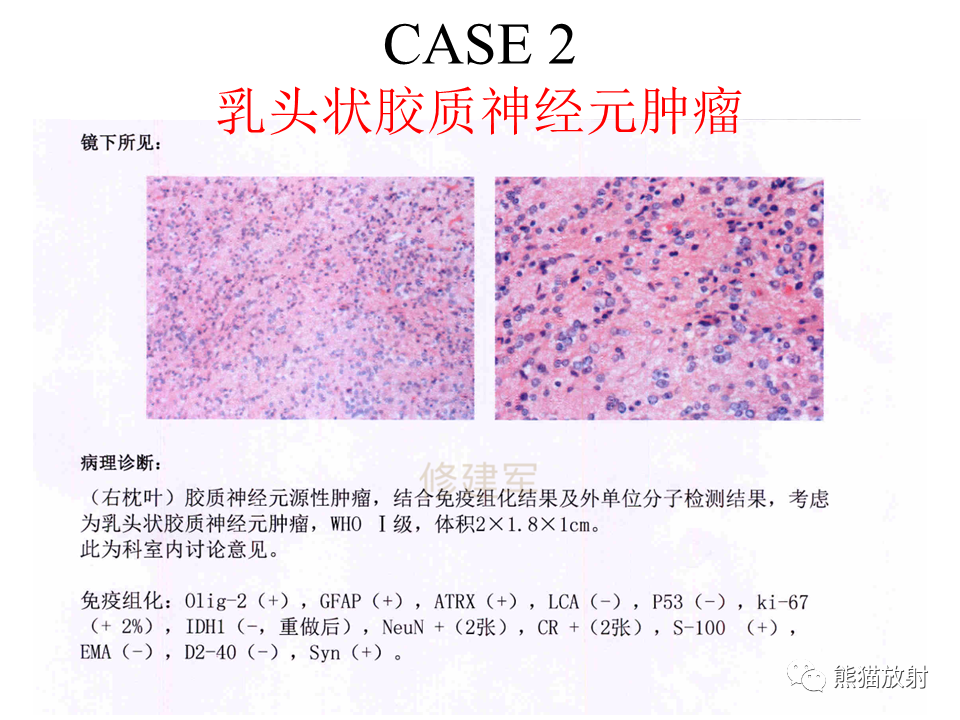 影像PPT - 【病例】伴菊形团形成的胶质神经元肿瘤 VS 乳头状胶质神经元肿瘤-17