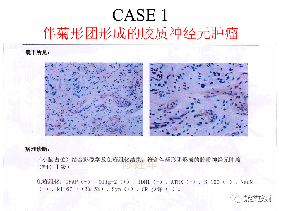 影像PPT - 【病例】伴菊形团形成的胶质神经元肿瘤 VS 乳头状胶质神经元肿瘤-16