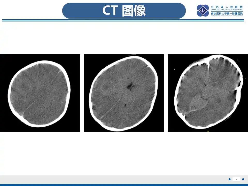 影像PPT - 【PPT】瑞氏综合征-8