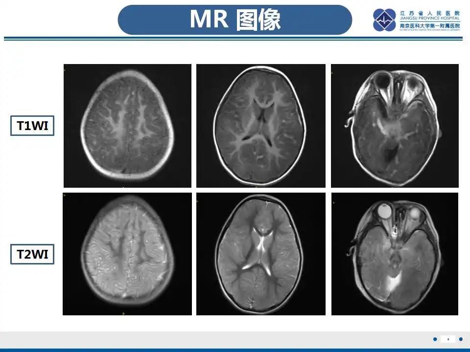 影像PPT - 【PPT】瑞氏综合征-9