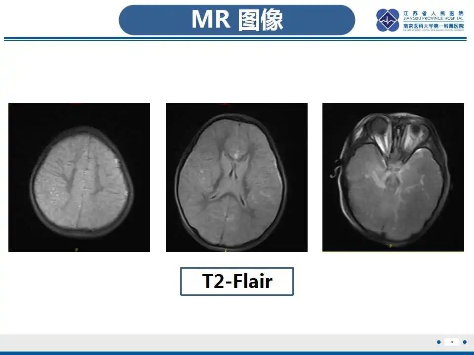 影像PPT - 【PPT】瑞氏综合征-10