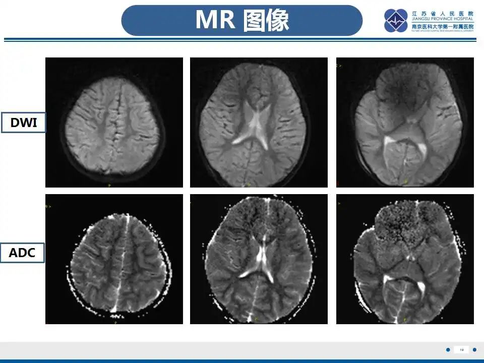 影像PPT - 【PPT】瑞氏综合征-11