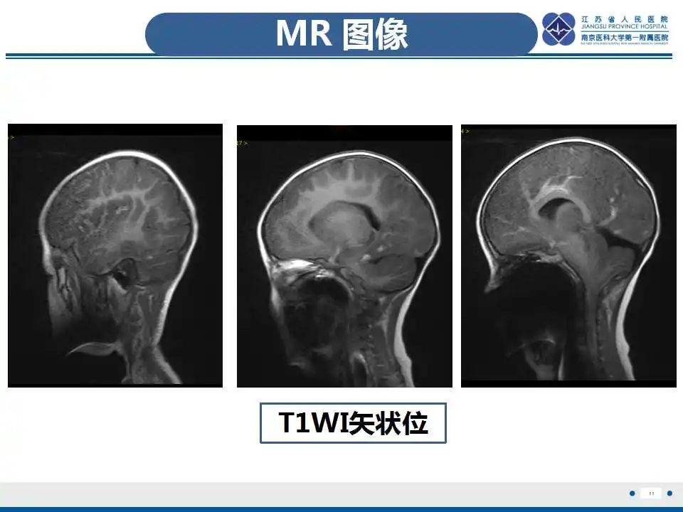 影像PPT - 【PPT】瑞氏综合征-12