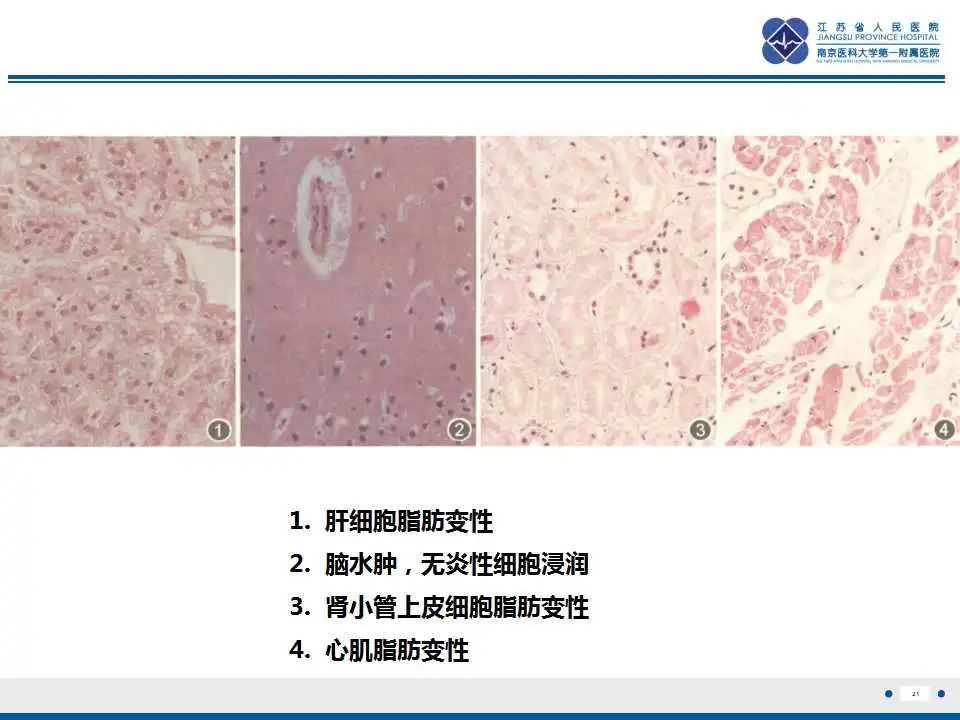 影像PPT - 【PPT】瑞氏综合征-22