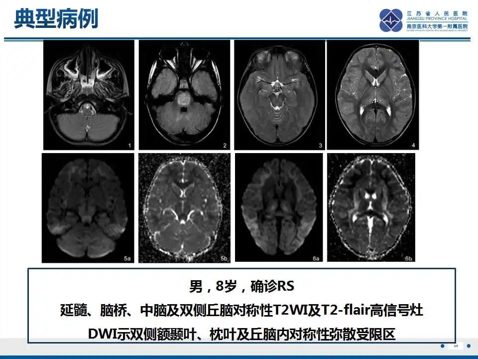 影像PPT - 【PPT】瑞氏综合征-26