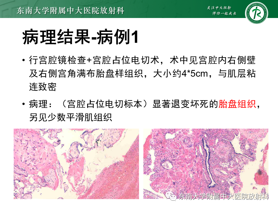 影像PPT - 【PPT】妊娠残留物的MR诊断及鉴别-7 影像PPT - 【PPT】妊娠残留物的MR诊断及鉴别-7