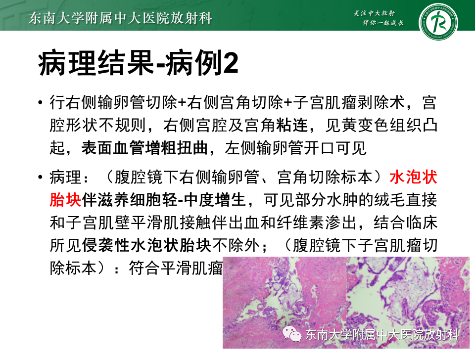 影像PPT - 【PPT】妊娠残留物的MR诊断及鉴别-8 影像PPT - 【PPT】妊娠残留物的MR诊断及鉴别-8