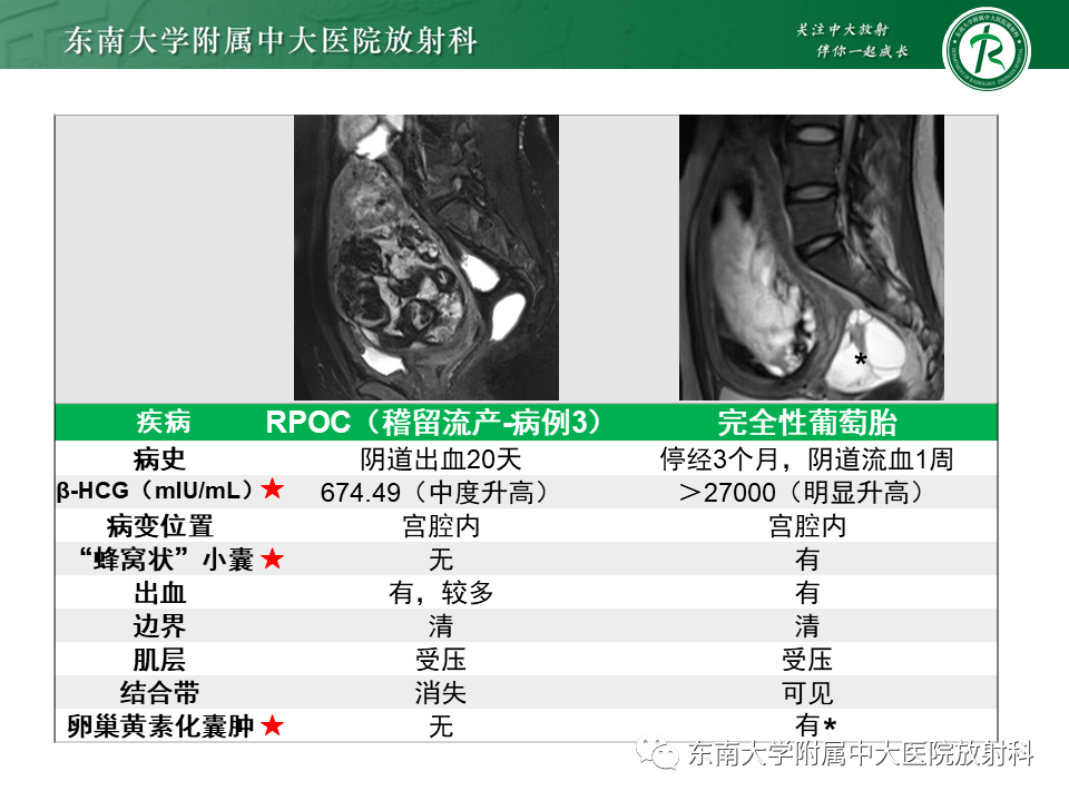影像PPT - 【PPT】妊娠残留物的MR诊断及鉴别-23 影像PPT - 【PPT】妊娠残留物的MR诊断及鉴别-23