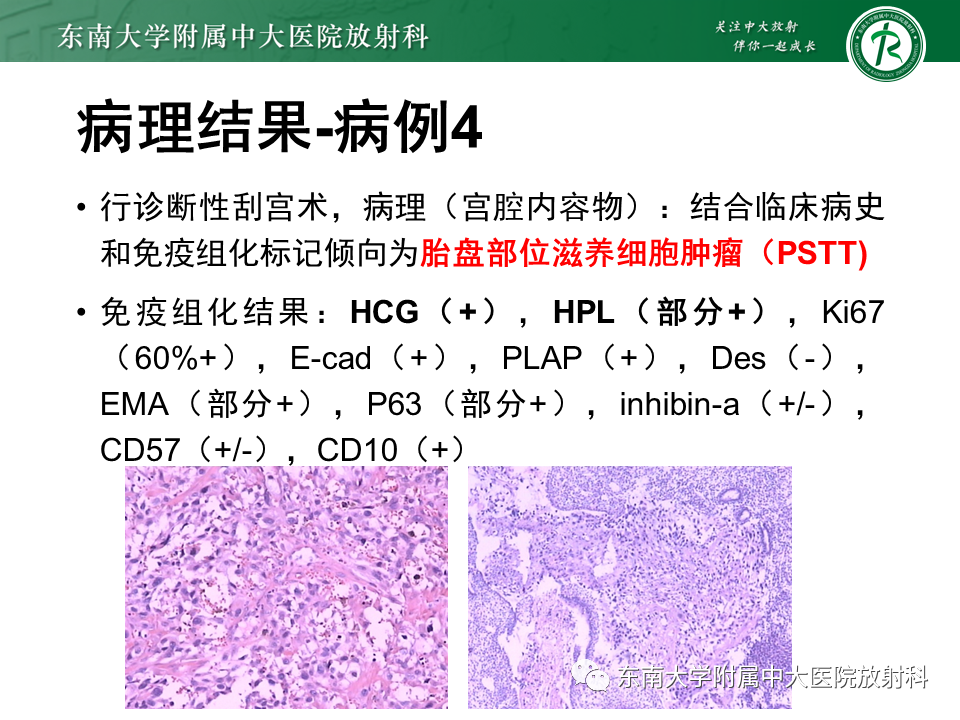 影像PPT - 【PPT】妊娠残留物的MR诊断及鉴别-10 影像PPT - 【PPT】妊娠残留物的MR诊断及鉴别-10