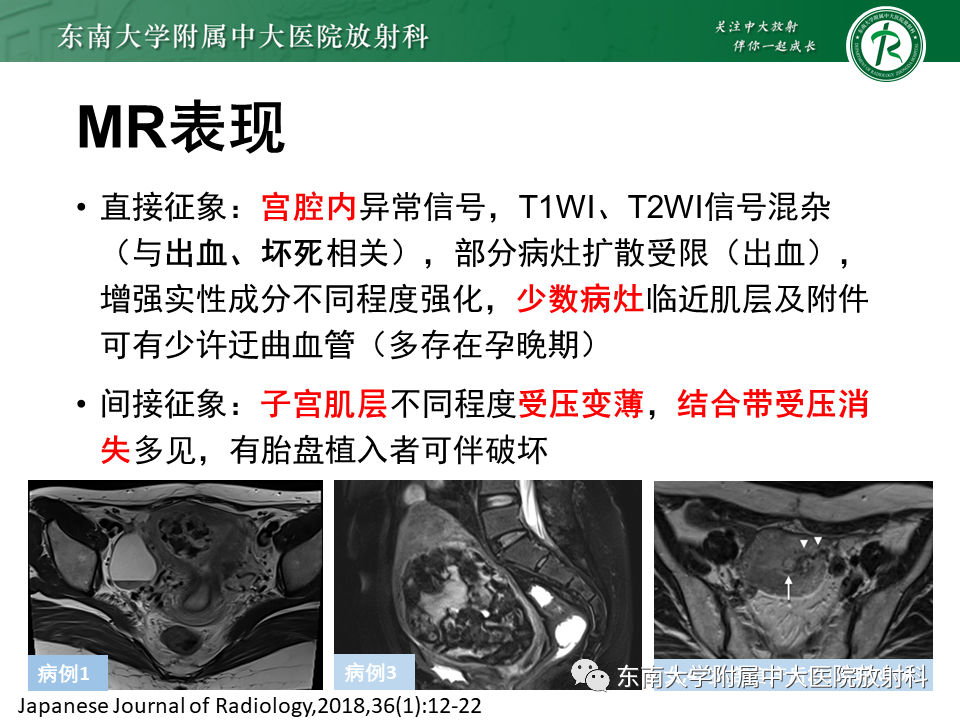 影像PPT - 【PPT】妊娠残留物的MR诊断及鉴别-17 影像PPT - 【PPT】妊娠残留物的MR诊断及鉴别-17