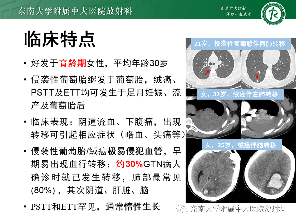 影像PPT - 【PPT】妊娠残留物的MR诊断及鉴别-20 影像PPT - 【PPT】妊娠残留物的MR诊断及鉴别-20