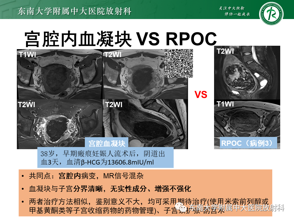 影像PPT - 【PPT】妊娠残留物的MR诊断及鉴别-32 影像PPT - 【PPT】妊娠残留物的MR诊断及鉴别-32