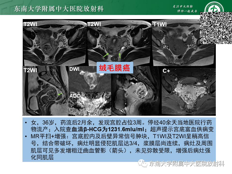 影像PPT - 【PPT】妊娠残留物的MR诊断及鉴别-25 影像PPT - 【PPT】妊娠残留物的MR诊断及鉴别-25