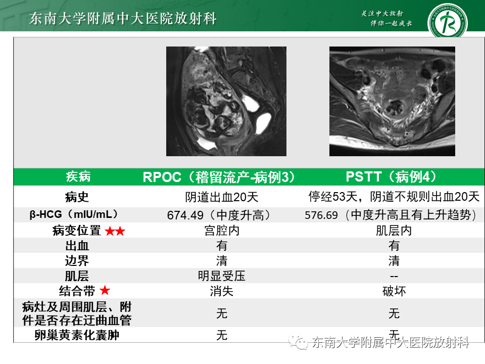影像PPT - 【PPT】妊娠残留物的MR诊断及鉴别-28 影像PPT - 【PPT】妊娠残留物的MR诊断及鉴别-28