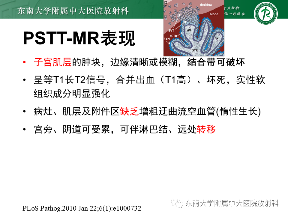 影像PPT - 【PPT】妊娠残留物的MR诊断及鉴别-27 影像PPT - 【PPT】妊娠残留物的MR诊断及鉴别-27