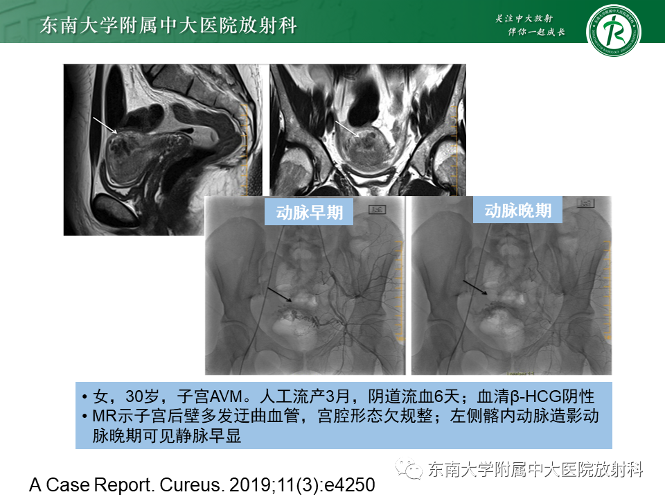 影像PPT - 【PPT】妊娠残留物的MR诊断及鉴别-30 影像PPT - 【PPT】妊娠残留物的MR诊断及鉴别-30