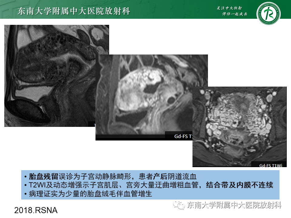 影像PPT - 【PPT】妊娠残留物的MR诊断及鉴别-31 影像PPT - 【PPT】妊娠残留物的MR诊断及鉴别-31