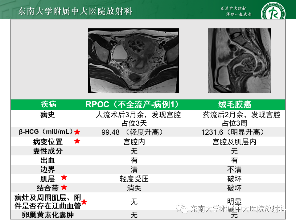 影像PPT - 【PPT】妊娠残留物的MR诊断及鉴别-26 影像PPT - 【PPT】妊娠残留物的MR诊断及鉴别-26