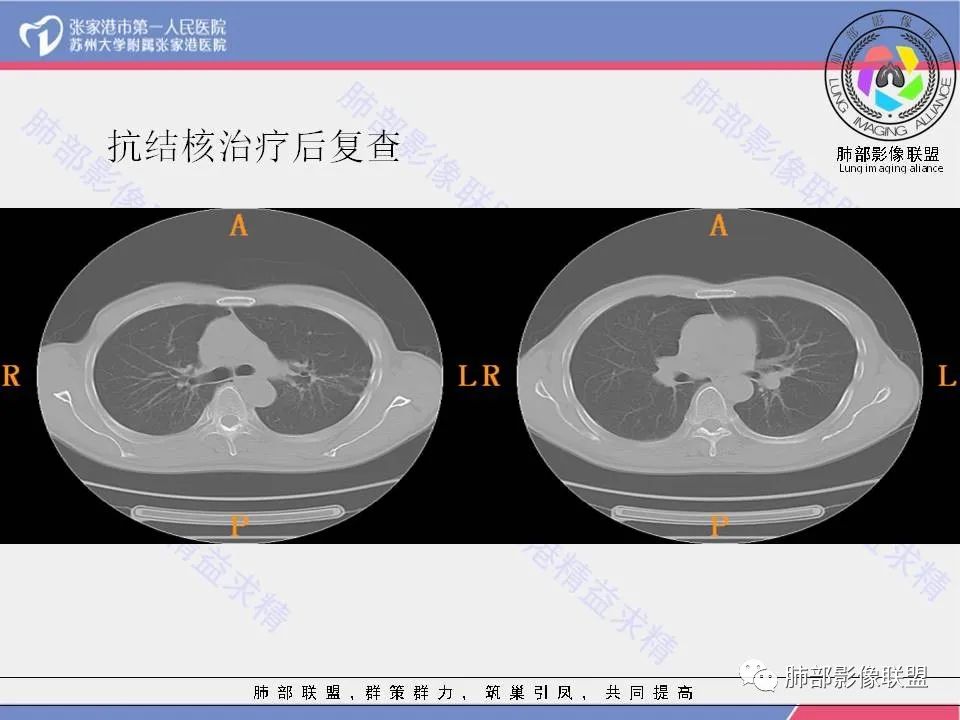 影像PPT - 【病例】“妖中之王”——肺结核-18 影像PPT - 【病例】“妖中之王”——肺结核-18