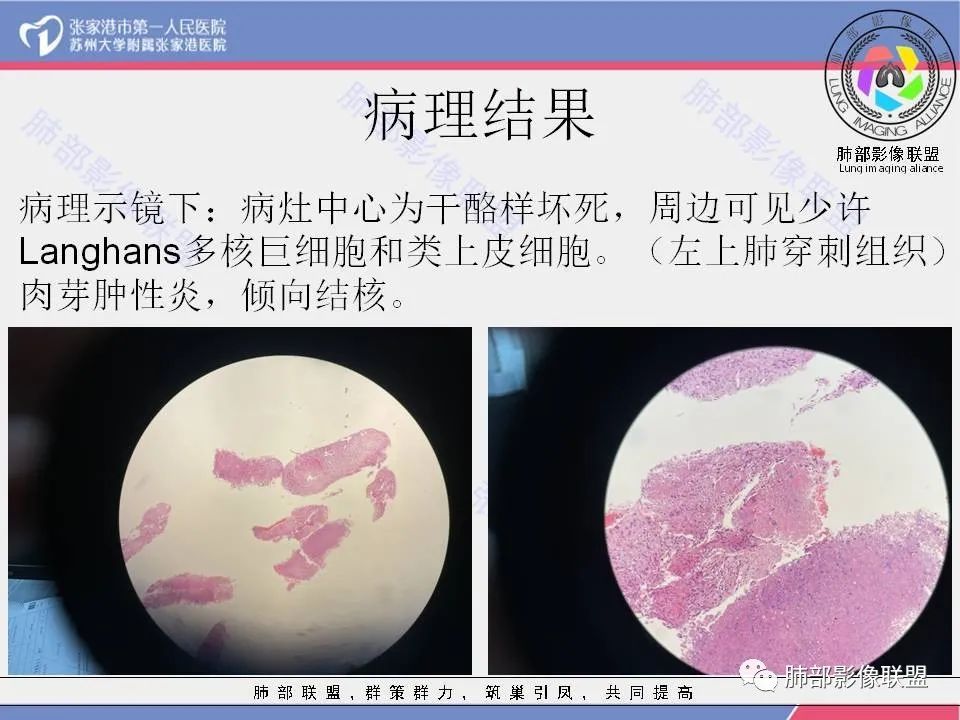 影像PPT - 【病例】“妖中之王”——肺结核-17 影像PPT - 【病例】“妖中之王”——肺结核-17