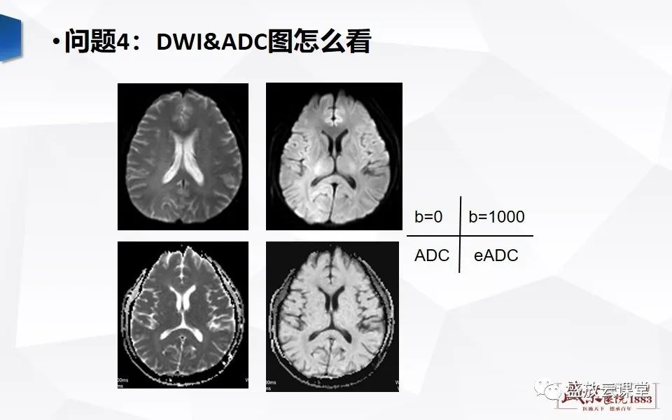 影像PPT - 【PPT】DWI成像原理及应用-6