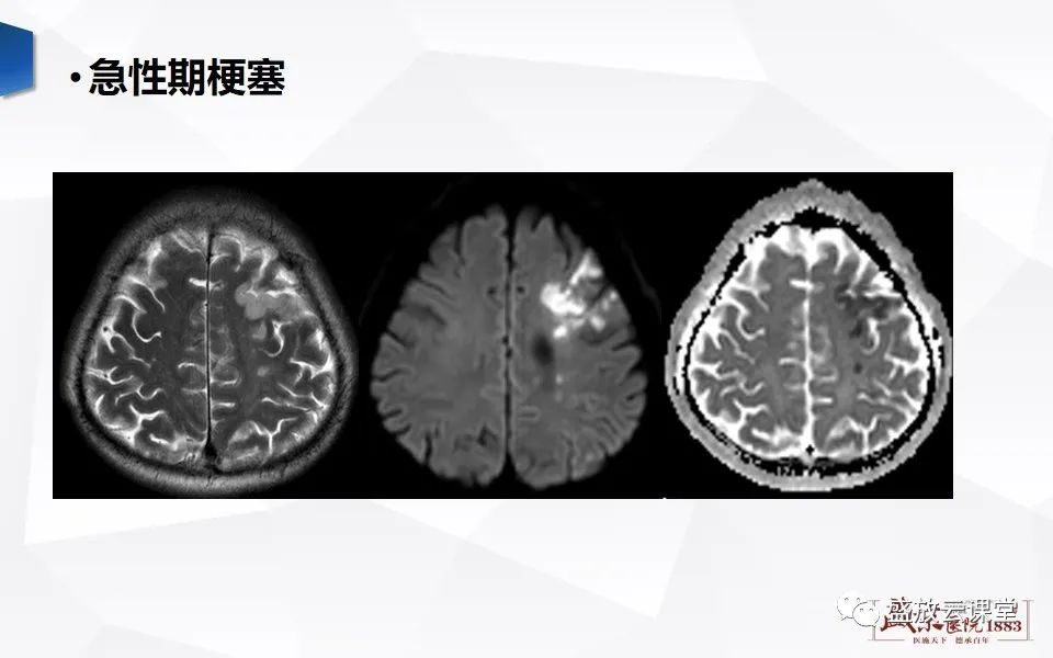 影像PPT - 【PPT】DWI成像原理及应用-12